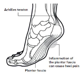 Plantar Fasciitis - SingHealth Duke-NUS Sport & Exercise Medicine