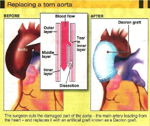 replacing a torn aorta - nhcs surgery