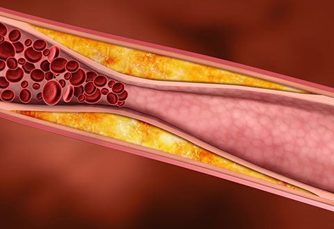 Close-up on narrowed artery - NHCS Murmurs