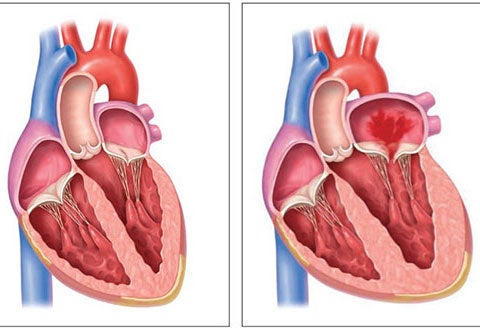 MitraClip therapy illustration