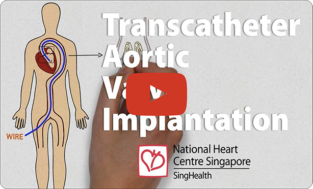 Heart Procedures - NHCS video thumbnail
