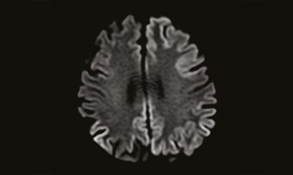  ​MRI showing Cortical Restricted Diffusion