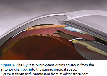 CyPass Micro-Stent - Singapore National Eye Centre