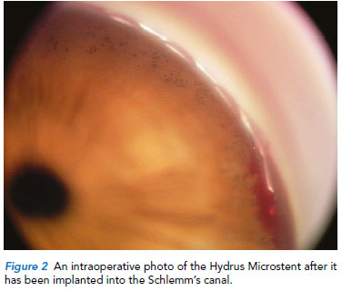 Hydrus microstent - Singapore National Eye Centre