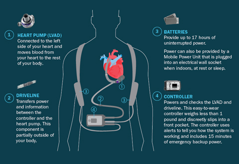LVAD on body