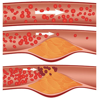 blocked artery illustration
