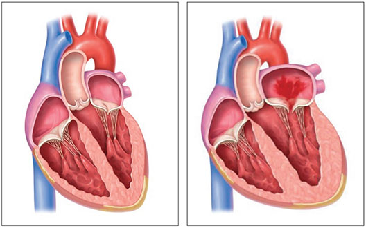 normal heart vs mitral regurgitation illustration