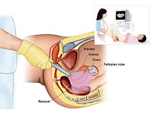 ultrasound scan for ovarian cancer