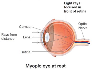 childhood myopia causes and risk factors