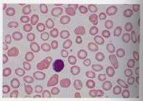 Anaemia cells
