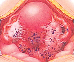 what is endometriosis and ovarian cysts