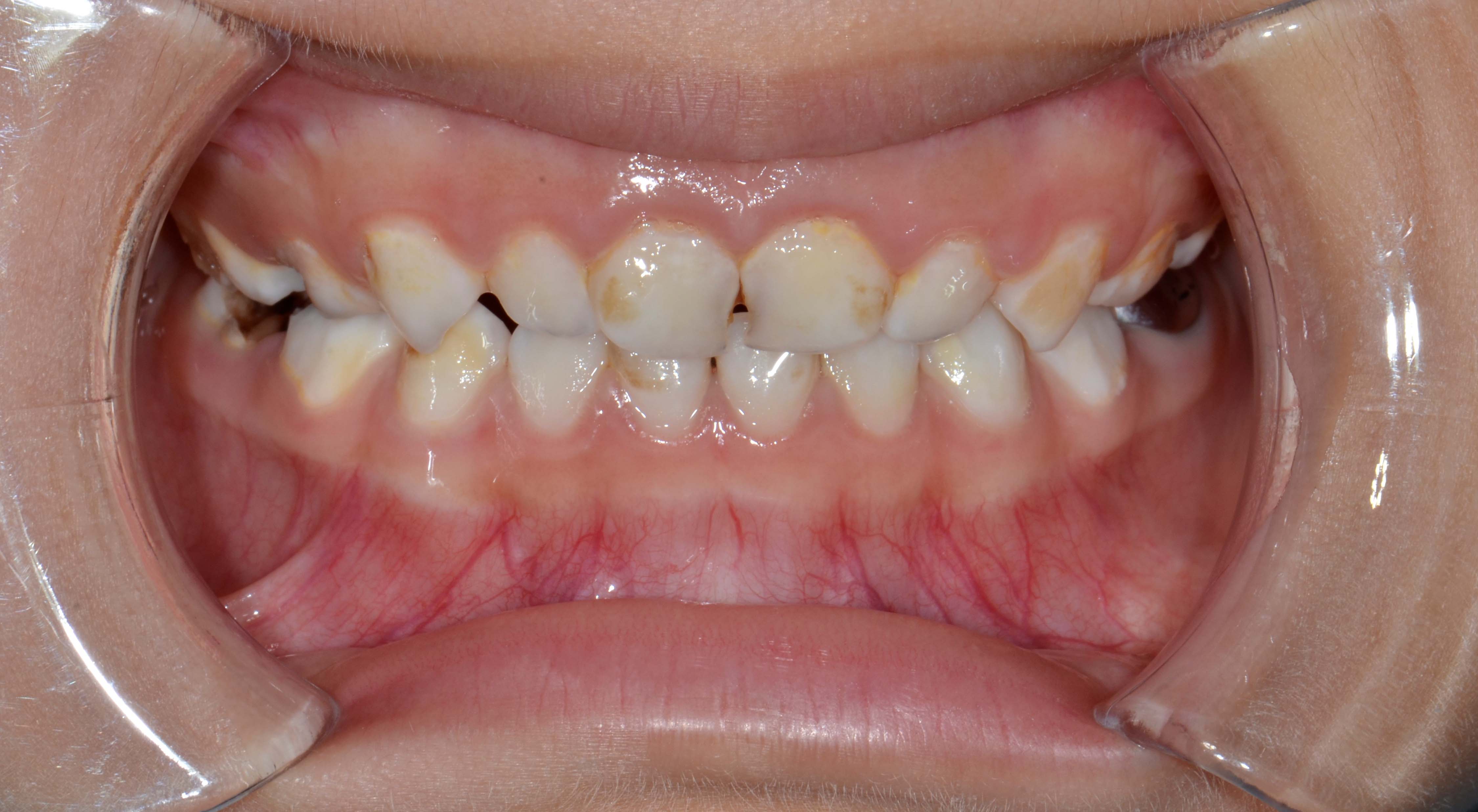 Poor oral hygiene in the primary dentition by the National Dental Centre Singapore