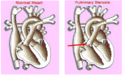 Pulmonary Stenosis / Regurgitation - Normal Heart vs Pulmonary Stenosis